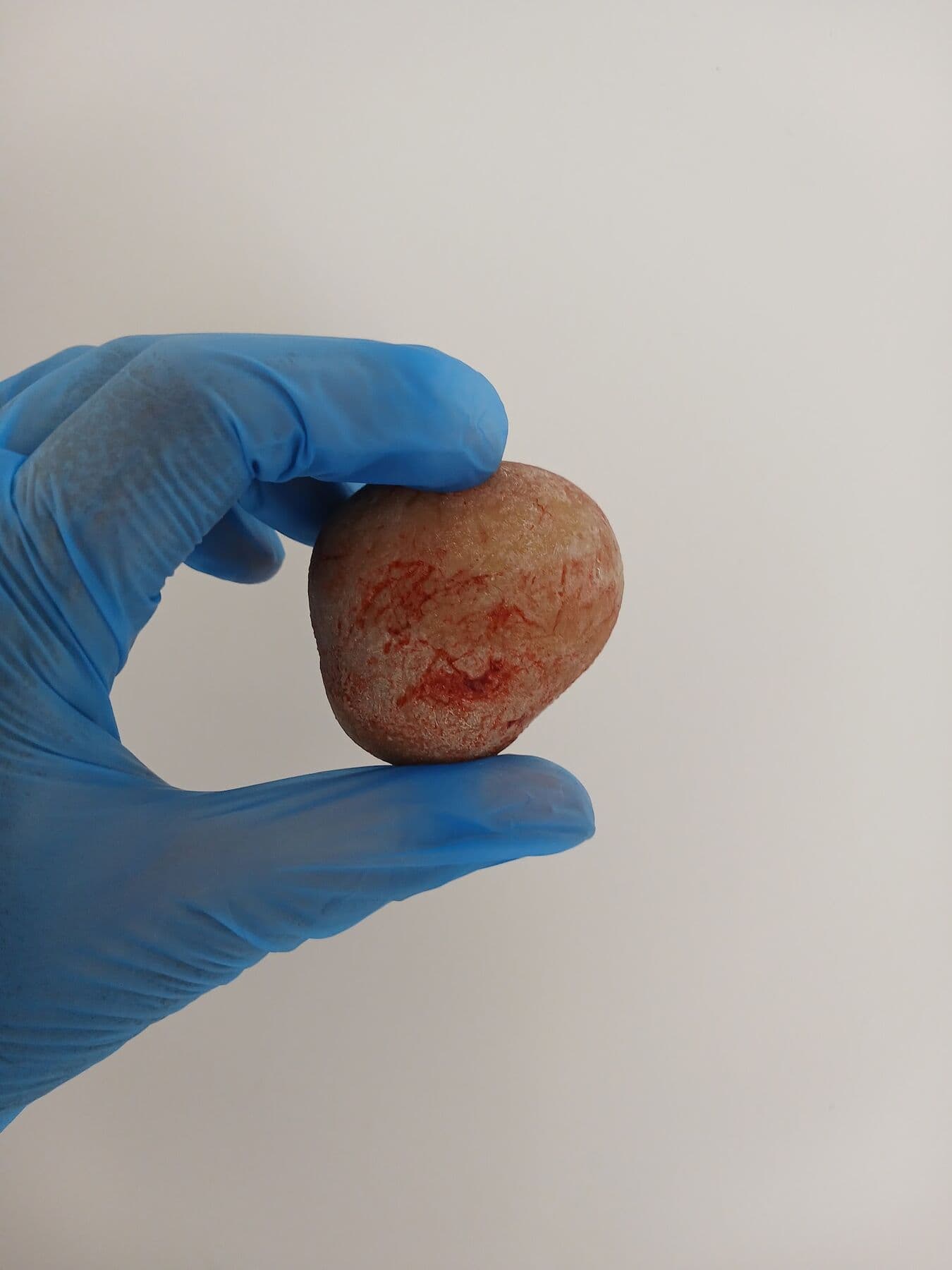 Una mano con guante azul sostiene un cálculo urinario del tamaño de una canica.